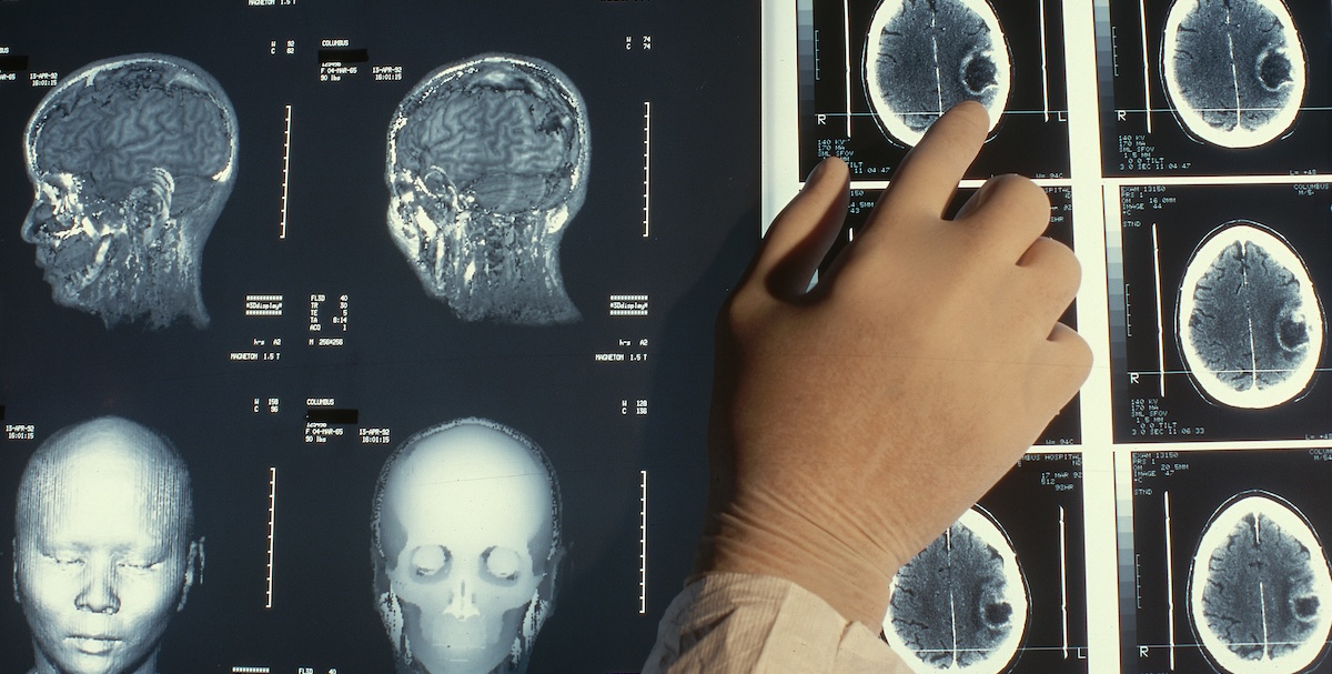 Intelligenza Artificiale e Salute: Diagnosi Accurate o Rischio di Allucinazioni Mediche?
