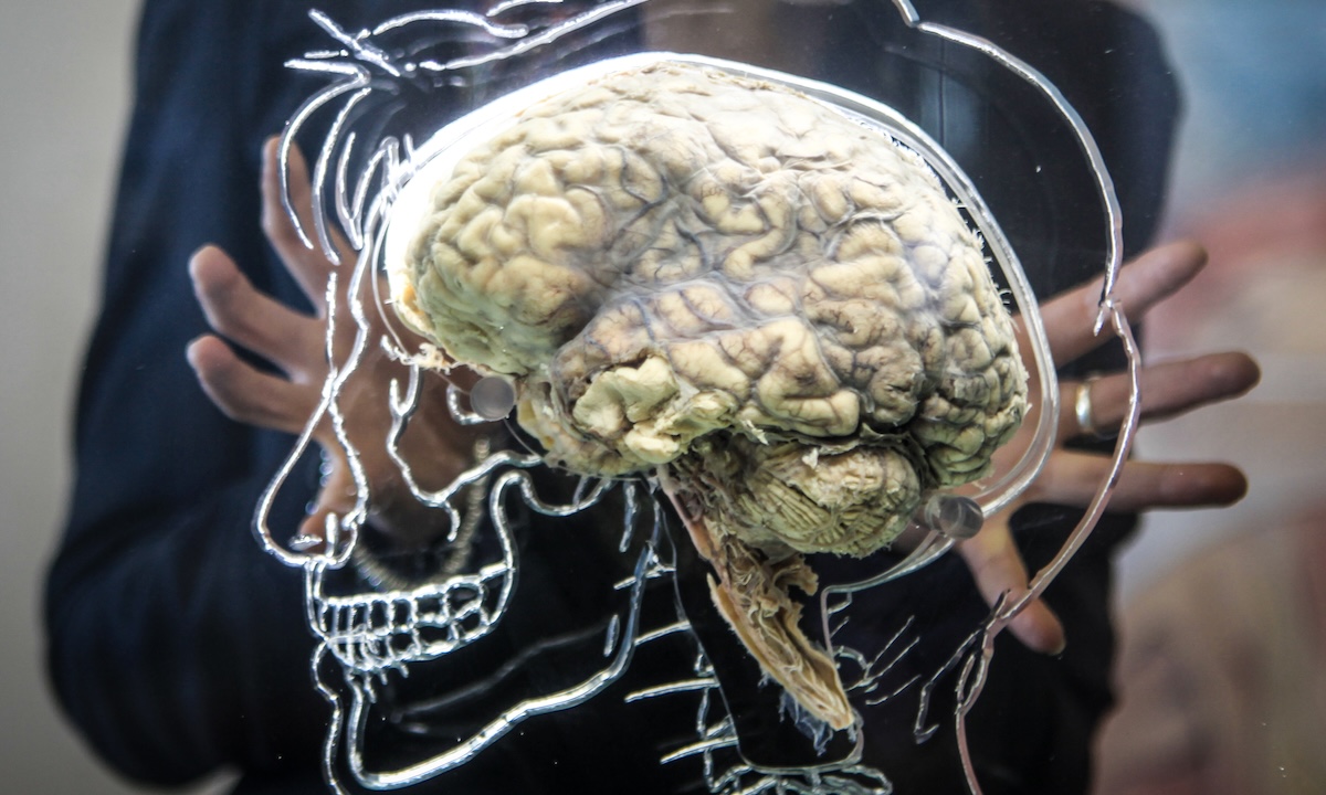 C’è un primo trattamento promettente contro la malattia di Huntington