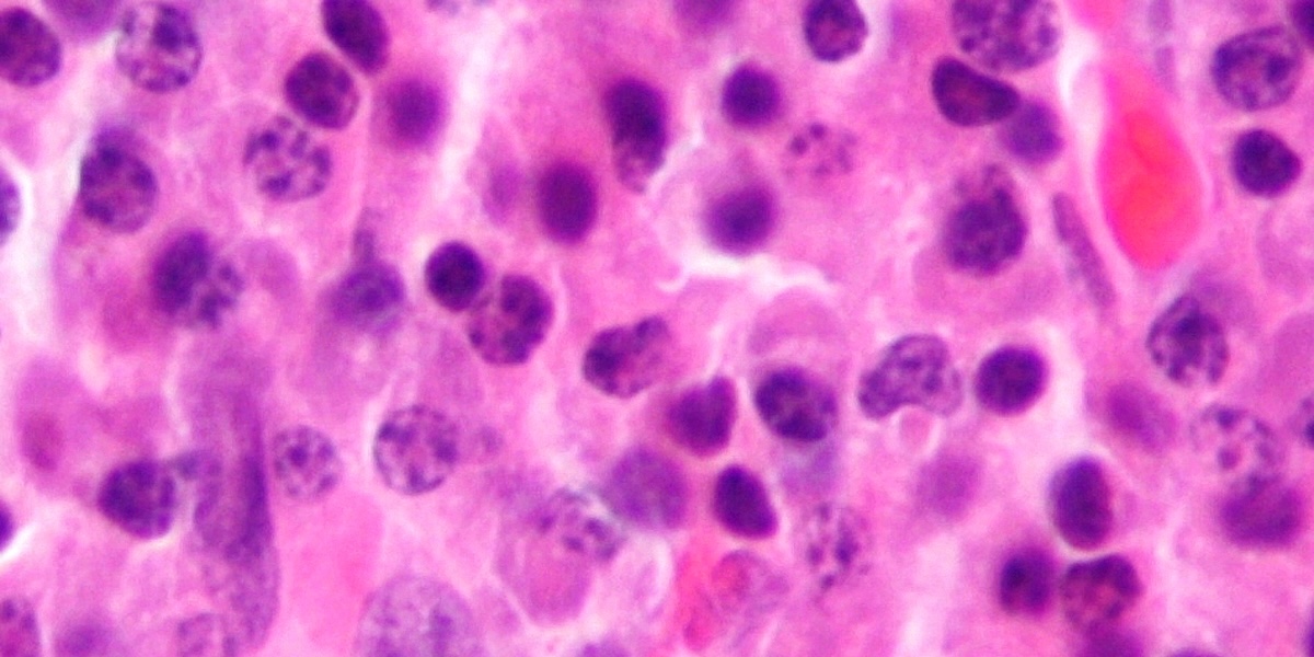 La giunta regionale dell’Andalusia ha pubblicato per errore i dati clinici di 23 pazienti malati di cancro